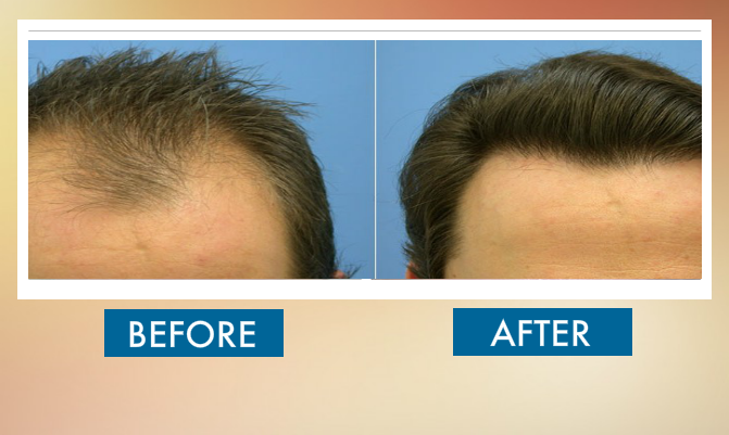 Before & After Hair Transplant - Sydney Hair Transplant Clinic
